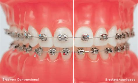 brackets autoligables metalicos|brackets autoligables beneficios.